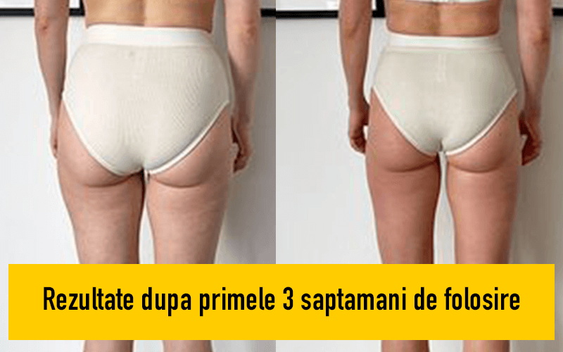 Rezultate-Coapse-Fara-Celulita-1